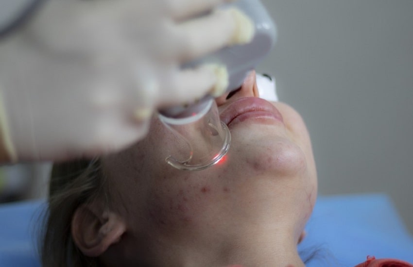 Acne giovanile ormonale: trattamenti definitivi